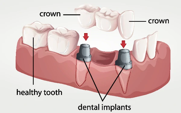 Dental Kopruler