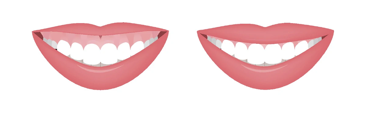Zahnfleischlächeln visuell