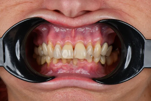 VORHER