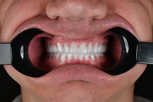 Korony cyrkonowe - PO