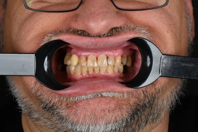 Implanty dentystyczne - PRZED