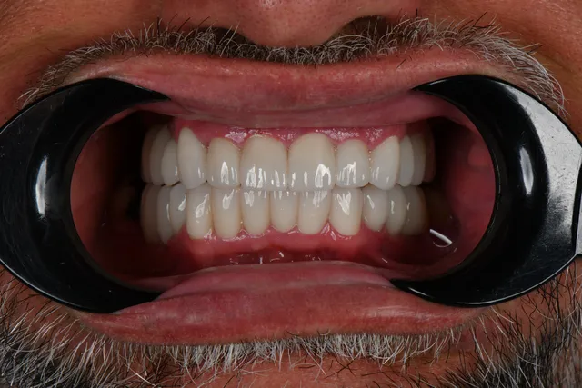 Implanty dentystyczne - PO