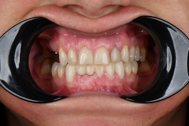 Implanty dentystyczne - PRZED