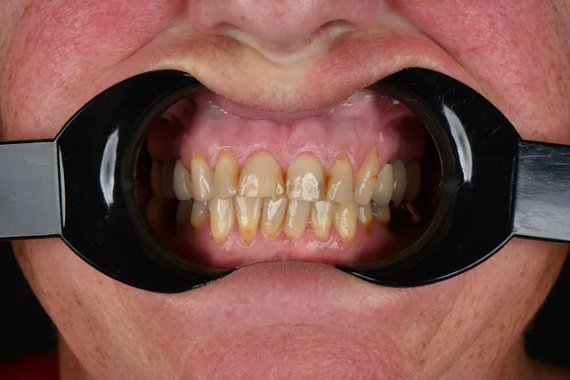 Implanty dentystyczne - PRZED