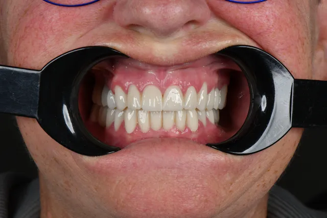Implanty dentystyczne - PO