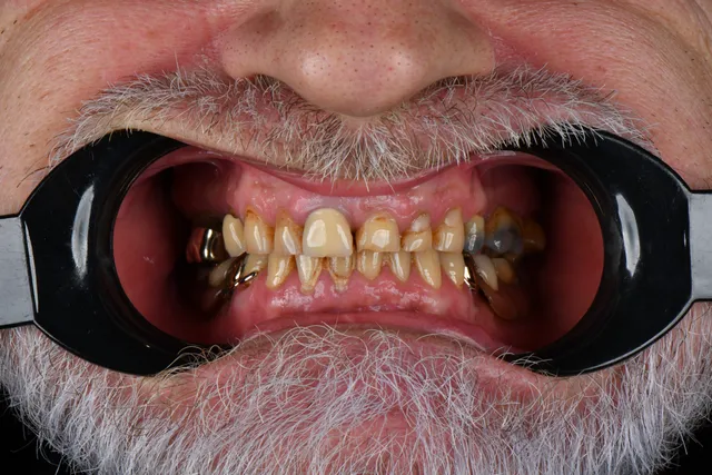 Implanty dentystyczne - PRZED
