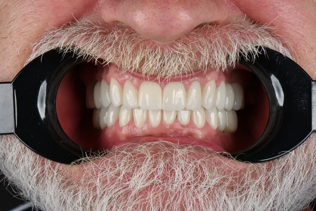 Implanty dentystyczne - PO