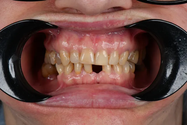 Implanty dentystyczne - PRZED