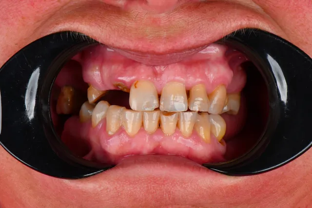 Implanty dentystyczne - PRZED