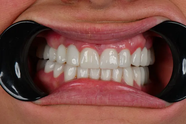 Implanty dentystyczne - PO