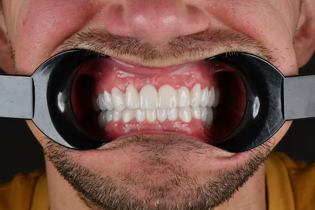 Implanty dentystyczne - PO