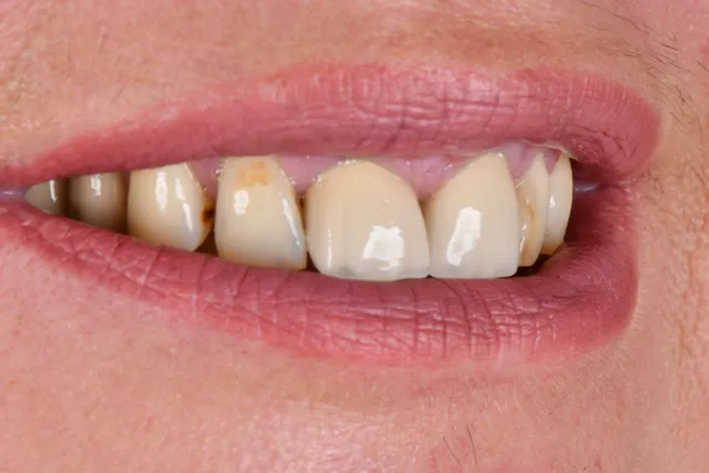 Implanty dentystyczne - PRZED