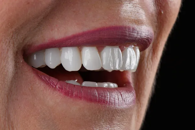 Implanty dentystyczne - PO