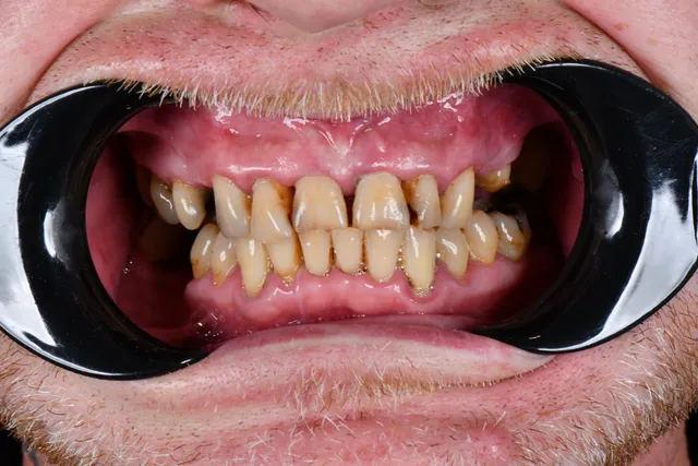 Implanty dentystyczne - PRZED