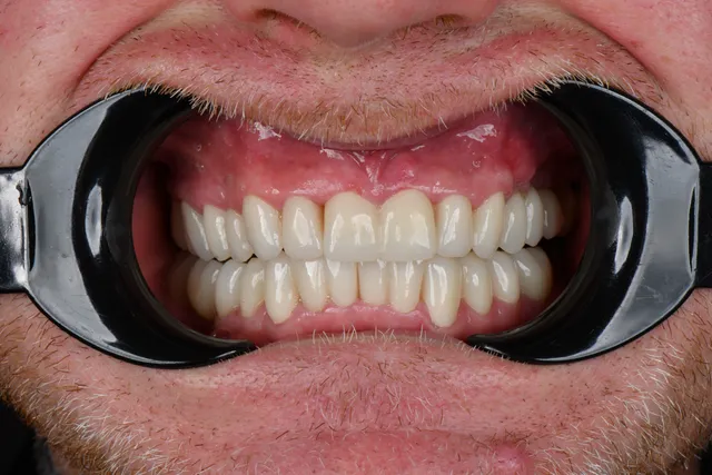 Implanty dentystyczne - PO