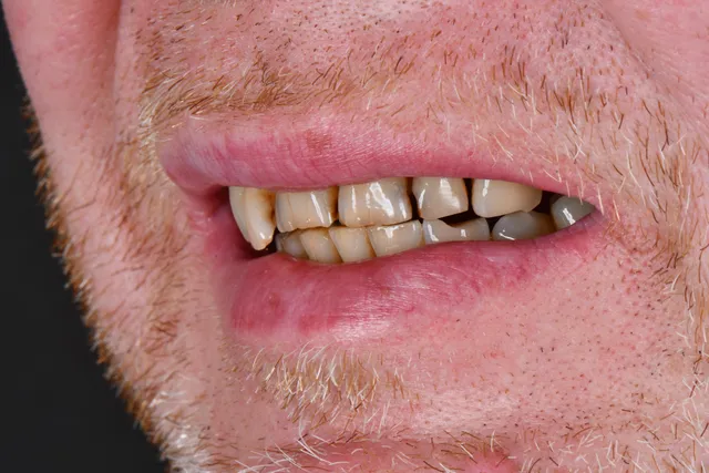 Implanty dentystyczne - PRZED
