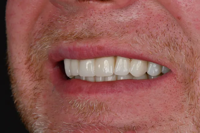Implanty dentystyczne - PO