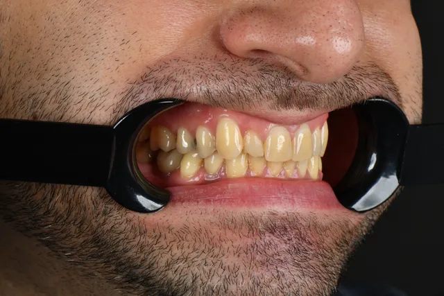 Implanty dentystyczne - PRZED