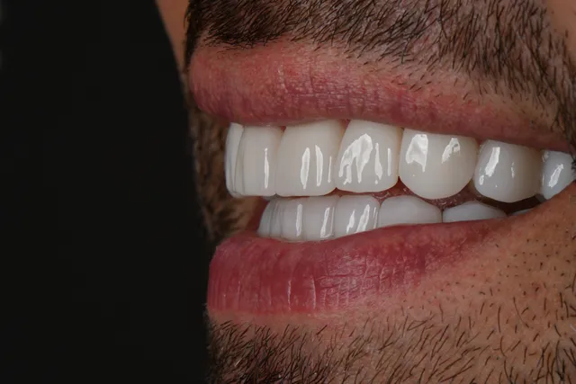 Implanty dentystyczne - PO