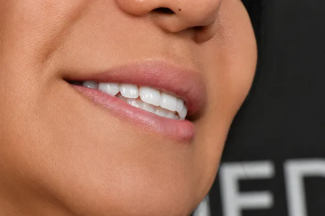 Zygoma Implants 1